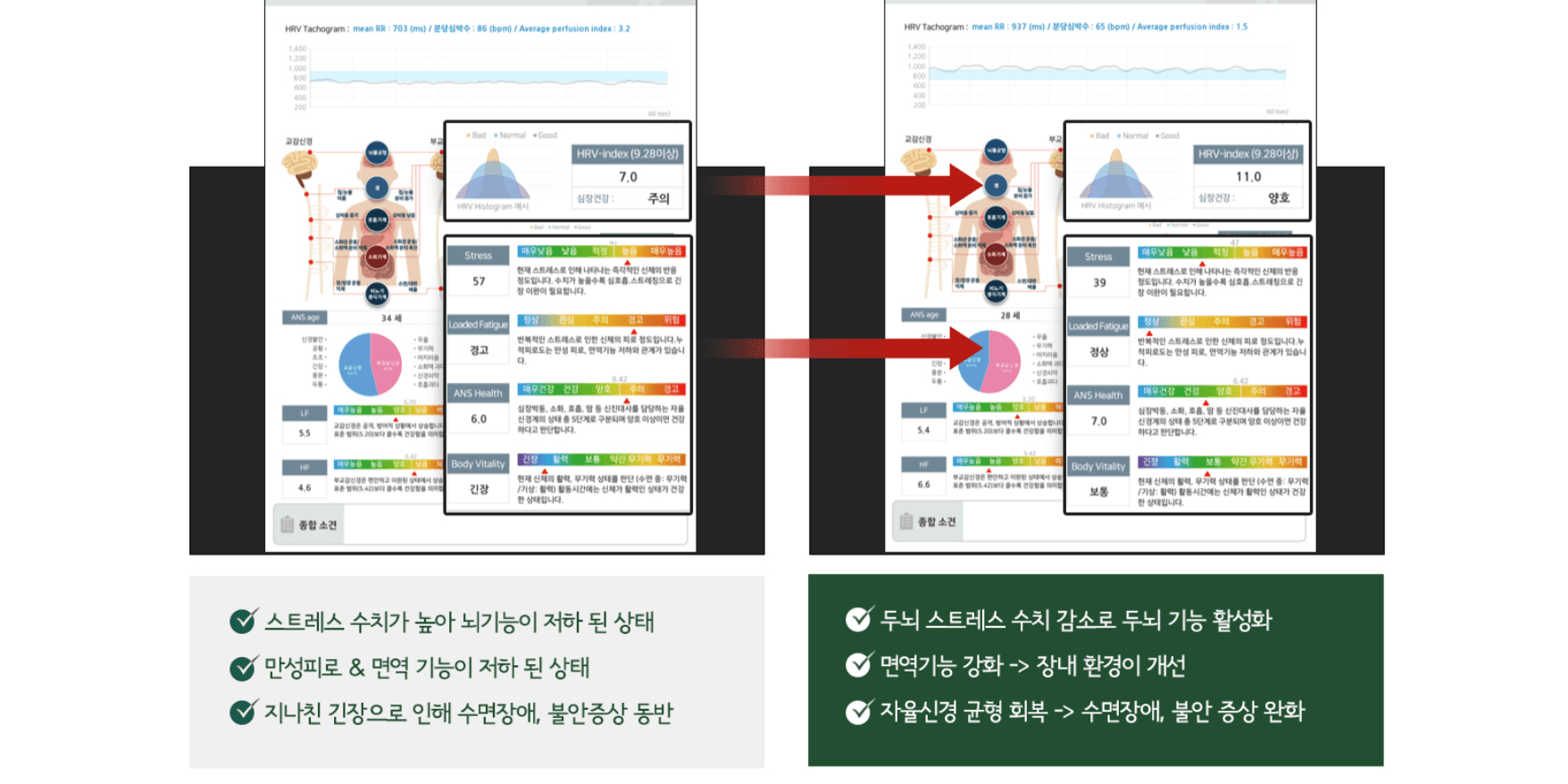 뇌파 자율신경검사 전후
